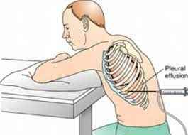 Pleural taping (removal of water from the lungs)