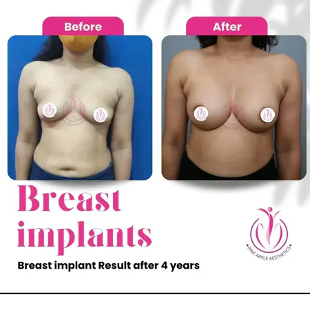 Breast implant surgery in Bangalore Breast implant surgery in Bangalore