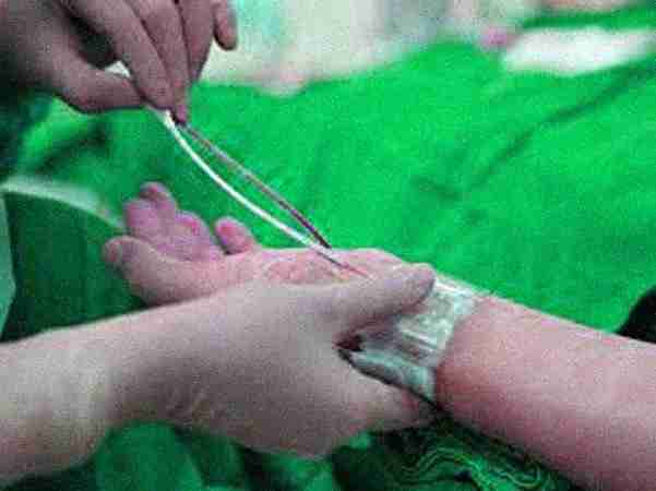 Angiography Angiography