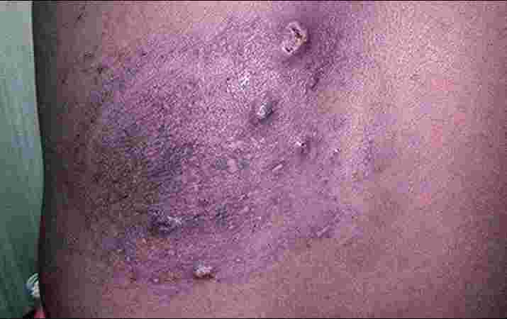 Fungal infections Fungal infections