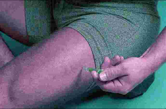 Hormone Replacement Therapy