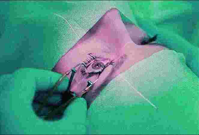 MAXI VISION SUPER SPECIALITY EYE HOSPITAL TRICHY MAXI VISION SUPER SPECIALITY EYE HOSPITAL TRICHY